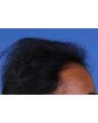 Before Hair Transplant&nbsp;Front